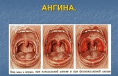 0010-010-Angina-600x450