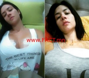 model-implant-burst-recovery