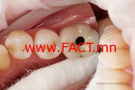 шүд-цоорох1